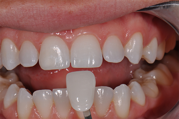 veneer2 tooth veneer treatment at avant dental clinic kolkata