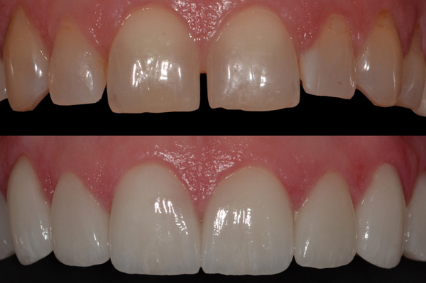 veneer3 tooth treatment at avant dental clinic kolkata