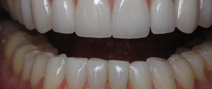 veneers1 teeth treatment at avant dental clinic kolkata