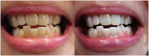 white teeth whitening before and after at avant dental clinic kolkata