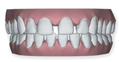 invisible brace at avant dental clinic kolkata