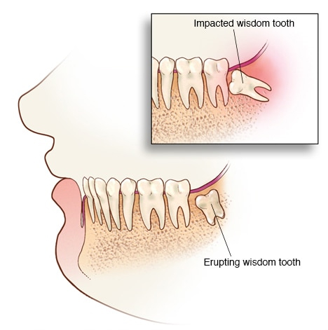 wisdom-tooth wsdom teeth issue at avant dental clinic kolkata
