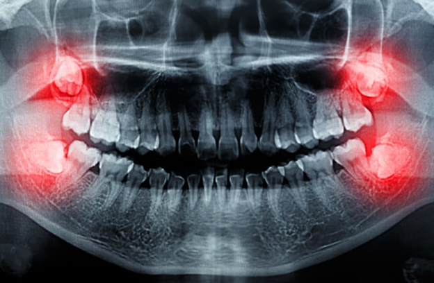 wisdom tooth pain report at avant dental clinic kolkata