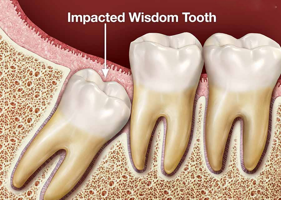 wisdom teeth problem at avant dental clinic kolkata