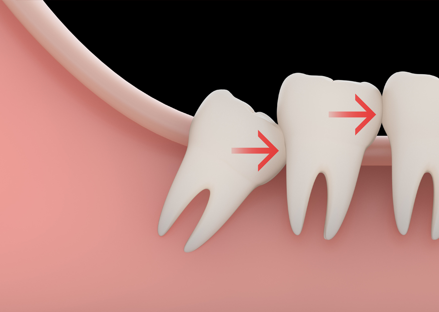 wisdom3 wisdom teeth problem at avant dental clinic kolkata