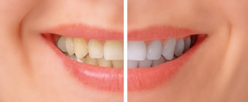 treatment before and after at avant dental clinic kolkata