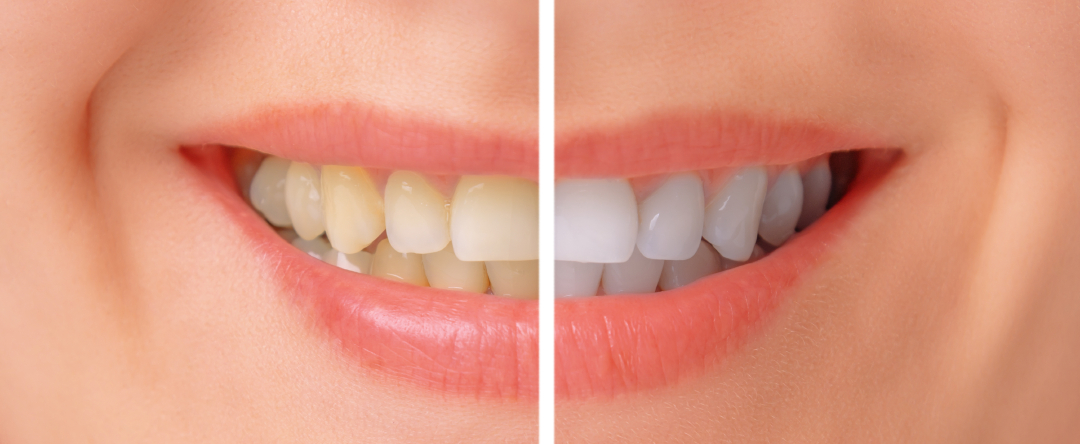 Teeth before and after whitening treatment before and after at avant dental clinic kolkata