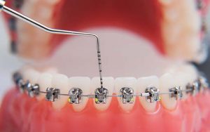 BRACES TREATMENT