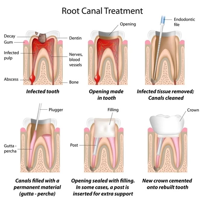 root canal treatment salt lake
