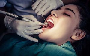 rootcanal treatment