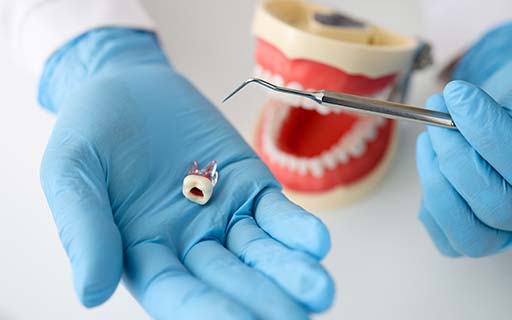 rootcanal kolkata