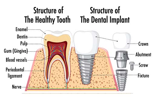 rootcanal
