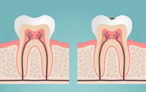root canal treatment